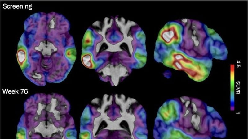This new Alzheimer’s drug targets a different brain protein, and is showing promise