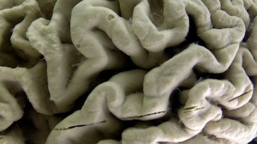 Research links blood test results to early Alzheimer’s