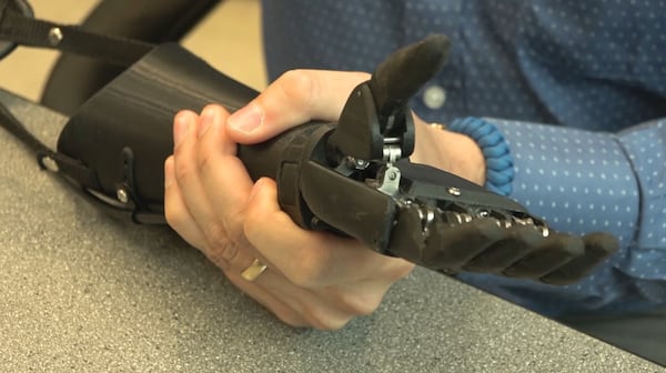 Victoria Hand Project heading to Nepal to outfit amputees with prosthetic arms