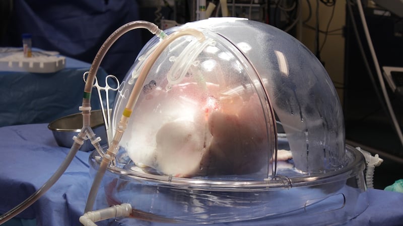 Toronto surgeon’s gene, stem cell therapy could make donor lungs ‘look more like itself’
