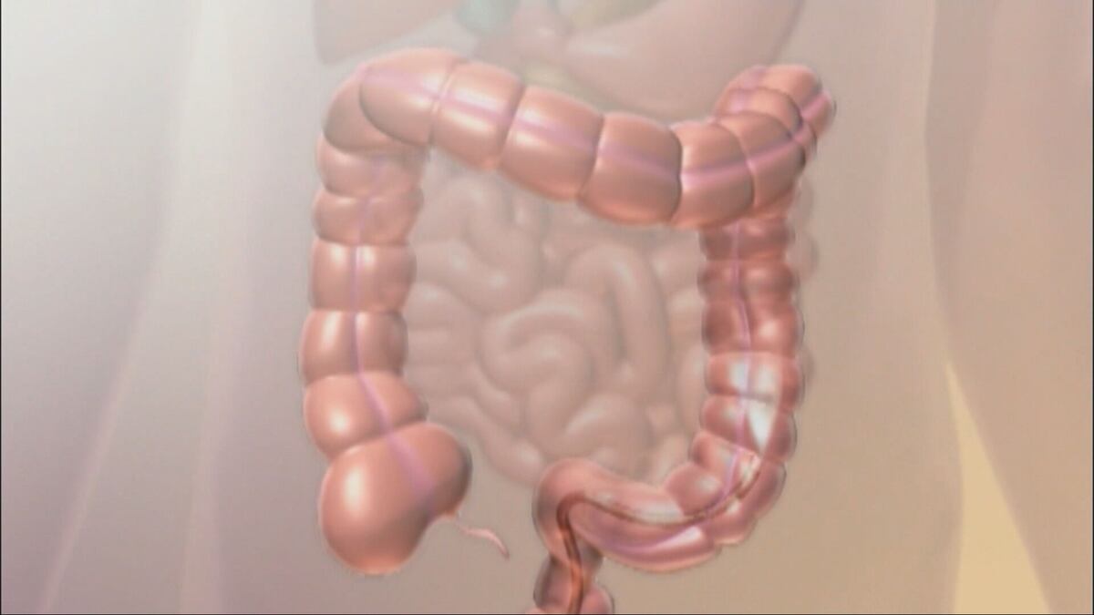 Colorectal cancer is killing more young adults, but stigma keeps them from talking about it — image 1