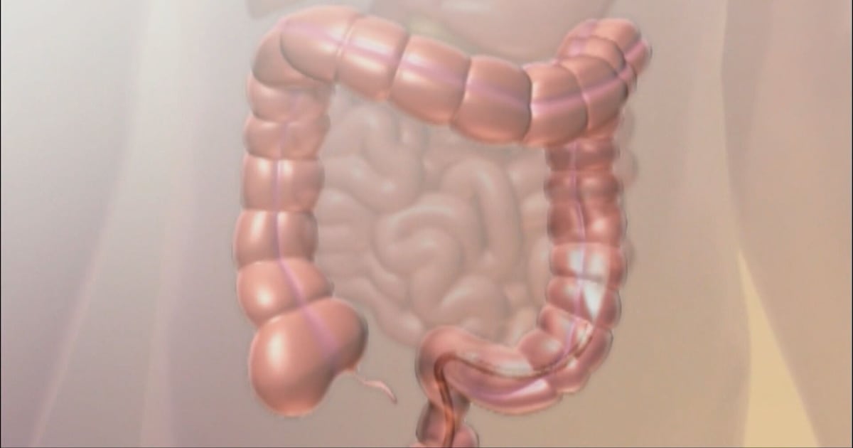 Colorectal Cancer : ce qu'il faut savoir — image 2