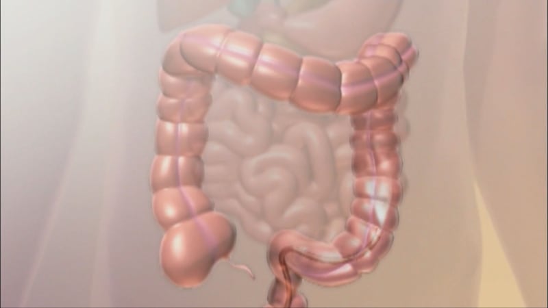 Colorectal cancer is preventable: Here’s how to get screened
