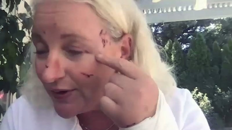 Woman left with nearly 40 stitches after otter attack