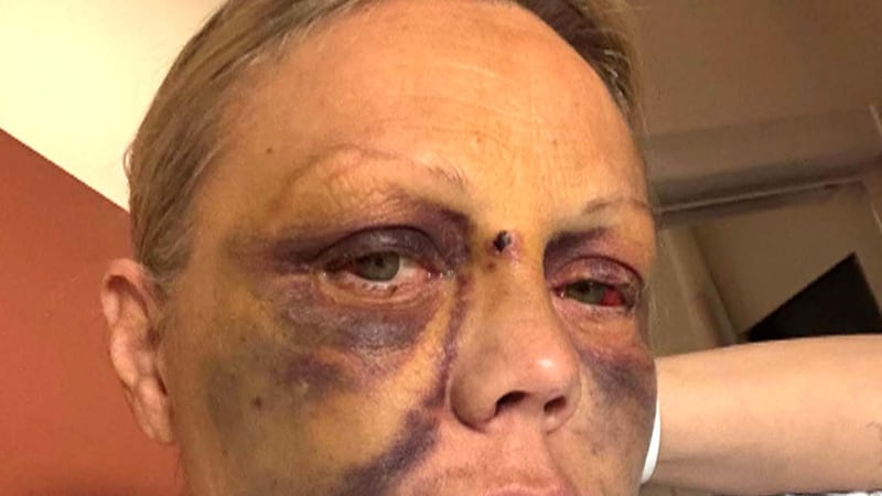 Calgary woman speaks out after brutal attack on CTrain platform