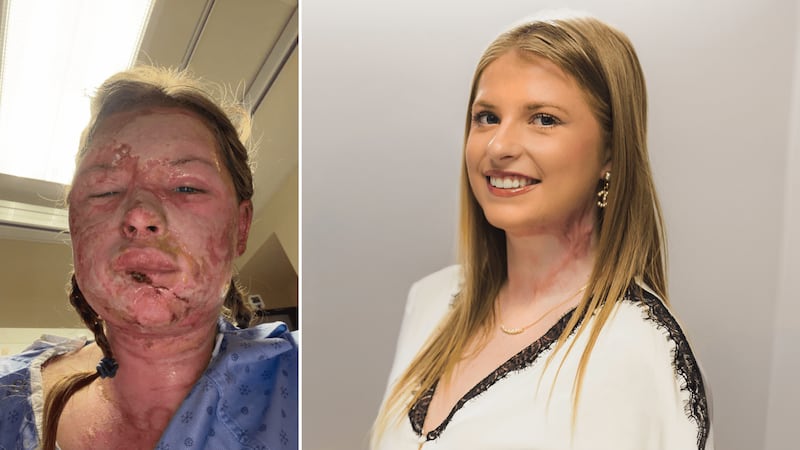 Burn experts treat woman injured during London, Ont. frat house fire using world-first biological treatment