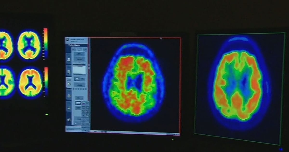Brain aneurysm warning signs - CTV News