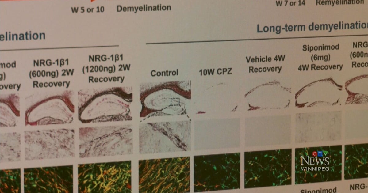 U of M team announce major MS treatment breakthrough - CTV News