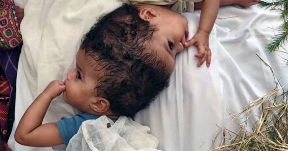 Twin sisters born joined at the head successfully separated - CTV News